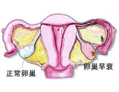 天伦专家分析：卵巢早衰如何检查
