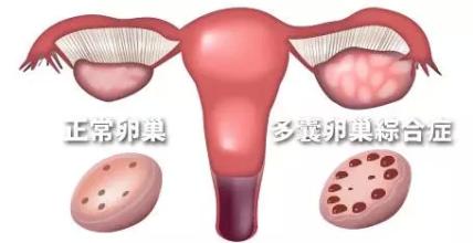 多囊卵巢怎么治
