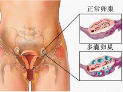 郑州多囊卵巢医院