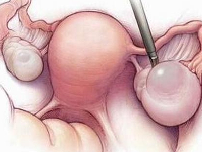 多囊卵巢是怎么得的？可以自愈吗？