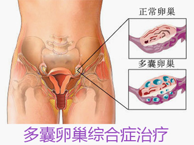 多囊卵巢综合症怎么治疗？哪种方法Ψ？