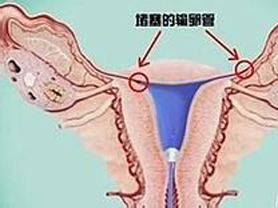 输卵管通液的副作用