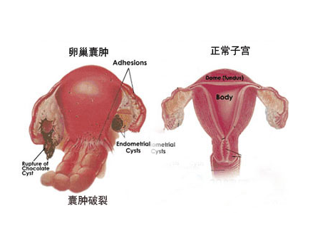 引发卵巢囊肿的病因是什么