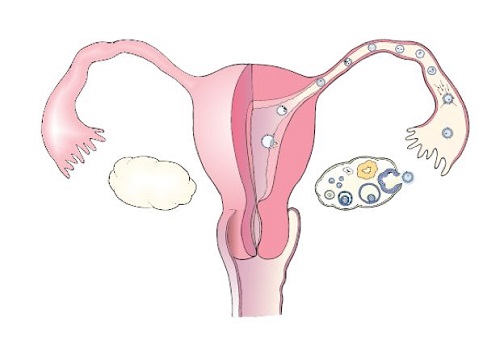 一侧输卵管通畅能怀孕吗？